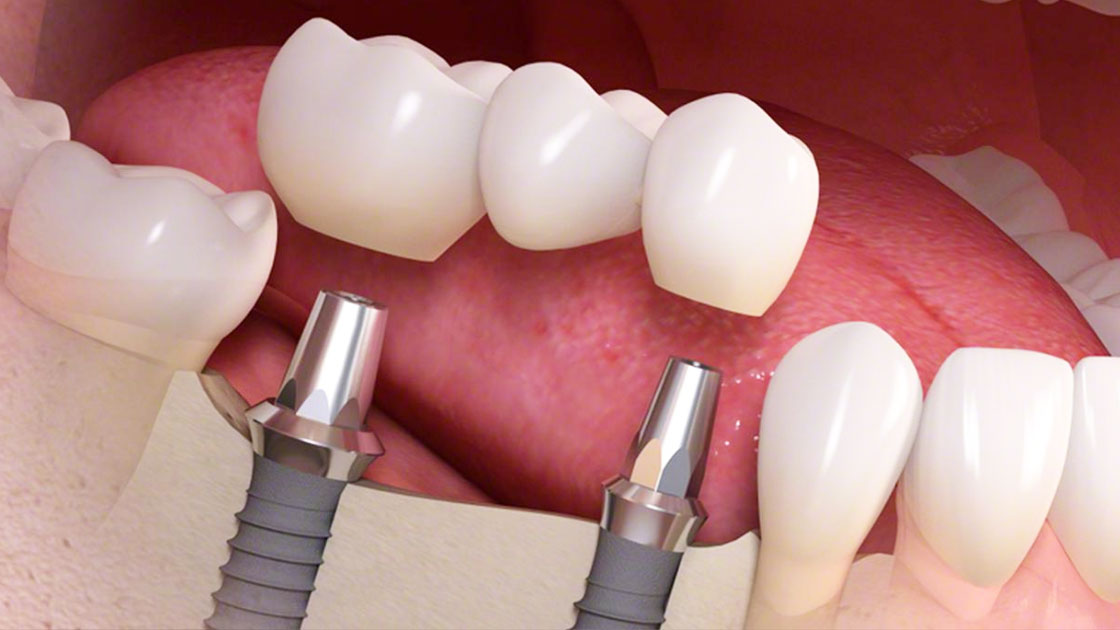 dental-crowns-and-bridges