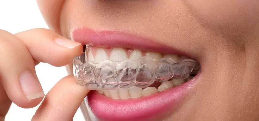 invisalign-tedavisi.jpg
